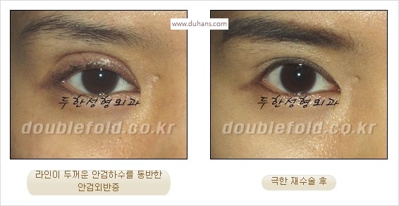 [두한성형외과 경쟁력 쌍꺼풀 재수술 스페셜] - [망가진 라인을 교정하는 극한 재수술] 관련 이미지 22