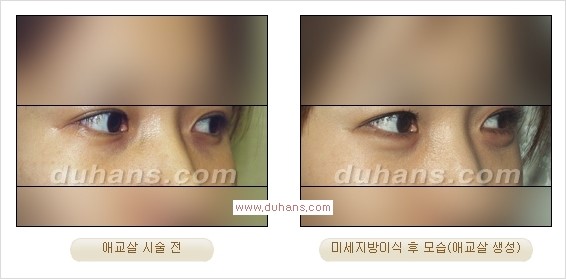 [두한성형외과 경쟁력 눈밑성형] - [눈밑애교살 시술을 위한 미세지방이식] 관련 이미지 19