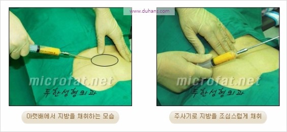 [두한성형외과 경쟁력 동안성형 리더] - ​[미간주름, 이마주름, 안검성형, 이마거상술, 눈썹거상술] 관련 이미지 27