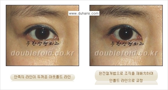 [두한성형외과] - [아웃폴드를 인폴드로 변화시키는 쌍꺼풀재수술] 관련 이미지 4