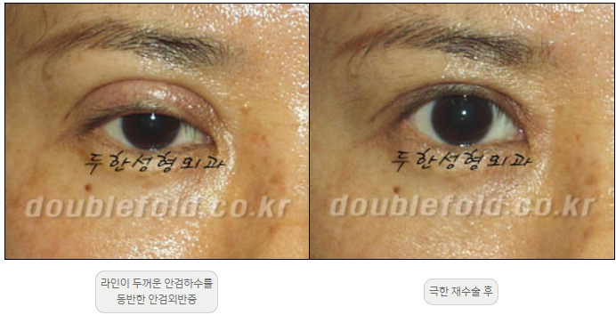 [Double Eyelid Surgery, Duhan Plastic Surgery] - [Extreme Revision Eye Surgery to Correct a Damaged Line] image 14