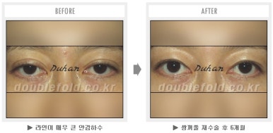 두한성형외과 쌍커풀 재수술 - 짝눈 눈매교정, 가성 안검하수 교정과 뒤밑트임 관련 이미지 37