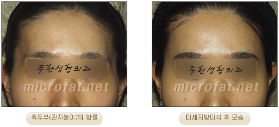 [두한성형외과 자가지방이식] - [관자놀이 교정] 관련 이미지 13