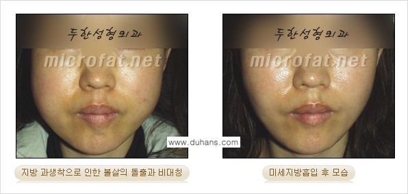 ​​​​[두한성형외과 경쟁력 미세지방이식] - [지방이식 부작용 - 지방이식 과다주입, 과다생착의 얼굴 모양에 대한 안내] 관련 이미지 1