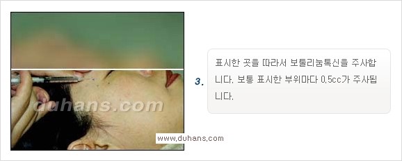 [두한성형외과 경쟁력 Quick 주름성형] - [주름교정을 위한 간편한 보톡스(보툴리눔톡신)] 관련 이미지 4