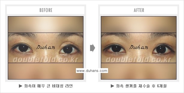 [두한성형외과 쌍꺼풀 재수술] - [피부 여유분이 부족해서 토안증이 발생한 경우] 관련 이미지 6
