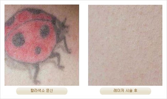 [두한성형외과 경쟁력 안전성형] - [최첨단 장비를 이용한 흉터, 점, 주근깨, 잡티, 문신제거 레이저 시술] 관련 이미지 28