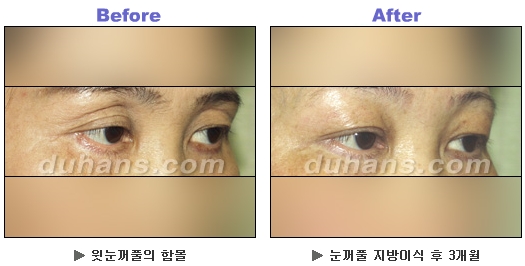 [두한성형외과 안검성형] - [상안검, 하안검] 관련 이미지 7