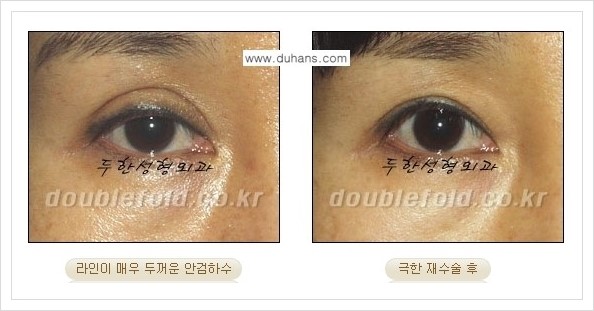 [두한성형외과 경쟁력 쌍꺼풀 재수술, 극한 재수술] - [망친 눈(쌍꺼풀) 복원수술과 일반 쌍꺼풀 재수술과의 차이점] 관련 이미지 5