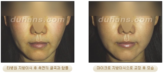 [두한성형외과 얼굴자가지방이식] - [볼살, 이마, 측두부] 관련 이미지 35