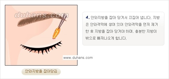 [두한성형외과 경쟁력 지방제거, 지방재배치] - [상큼하고 젊은 눈매 만들기 안내] 관련 이미지 6