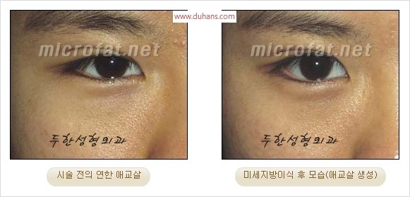 ​﻿[두한성형외과 경쟁력 지방이식] - [눈밑 애교살 시술을 위한 미세지방이식] 관련 이미지 22