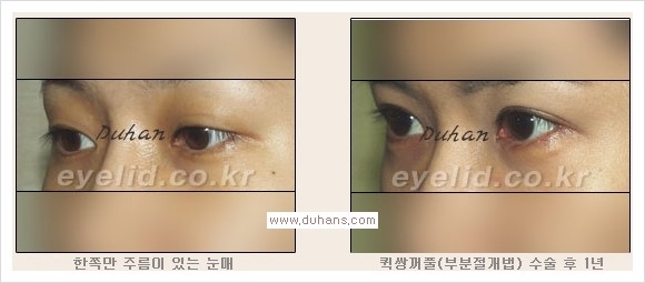 [두한성형외과 경쟁력 눈성형, 쌍꺼풀 수술] - [퀵쌍꺼풀(부분절개법)의 수술 안내] 관련 이미지 16
