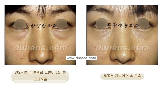 [두한성형외과 젊은 눈매 안검성형] - [눈밑 지방제거의 수술 전후 안내 ①] 관련 이미지 4