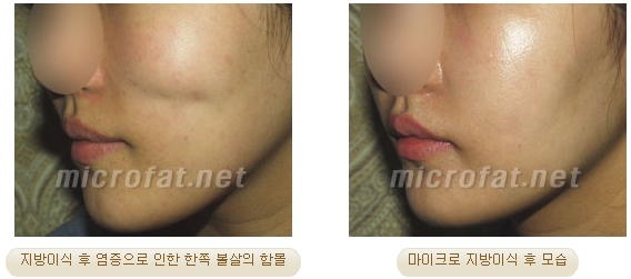 [두한성형외과 지방이식] - [타병원의 지방이식 부작용 교정] 관련 이미지 21