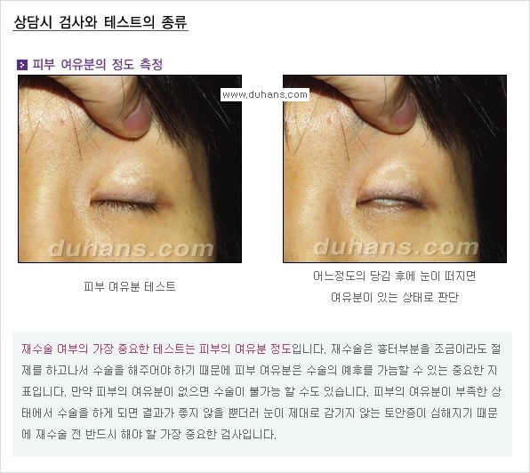[두한성형외과 경쟁력 쌍꺼풀 재수술, 극한 눈재수술] - [재수술에 대한 최선의 대안 제시] 관련 이미지 9