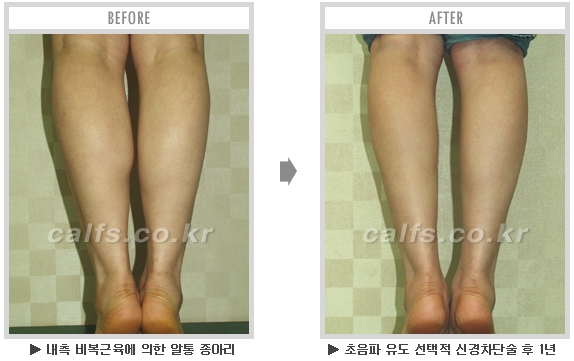 [종아리성형 두한성형외과] - [종아리수술에 대한 자주하는 질문과 답변 모음] 관련 이미지 71