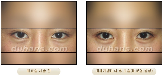 Duhan Plastic Surgery Under-Eye Surgery - Correction with Fat Grafting After Aegyo-Sal Filler image 12