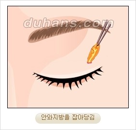 ⁠⁠[두한성형외과 경쟁력 안검성형] - [젊은 눈매를 위한 윗눈꺼풀 지방제거, 눈밑 지방제거] 관련 이미지 6