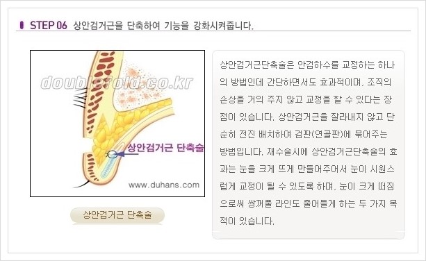 [두한성형외과 경쟁력 쌍꺼풀 재수술, 극한 재수술] - [쌍꺼풀 재수술의 과정 안내 1.] 관련 이미지 6