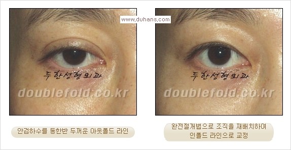[두한성형외과 경쟁력 눈성형] - [두꺼운 아웃폴드 라인을 인폴드 라인으로 교정] 관련 이미지 6