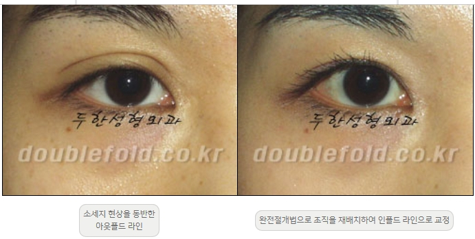 [Double Eyelid Surgery Duhan Plastic Surgery] - [Revision Methods] image 4