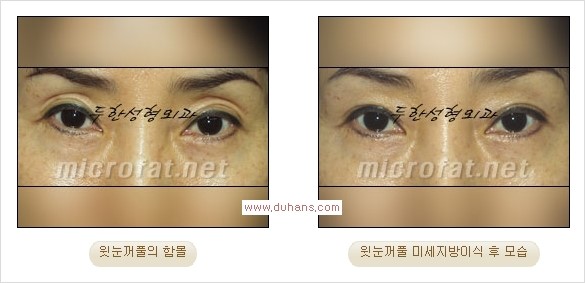 [두한성형외과 Dr. 컬럼] - [눈꺼풀의 지방이식] 관련 이미지 3