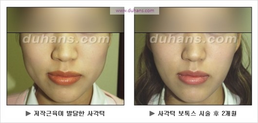 [두한성형외과 경쟁력 안면윤곽 성형 리더] - [완변한 V 라인! 턱 미세지방이식, 볼살 미세지방이식, 사각턱 보톡스 안내] 관련 이미지 39