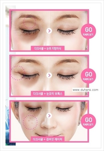 [두한성형외과 경쟁력 다크써클 교정] - [다크써클 5단계로 이뤄지는 핵심 5 STEP SOLUTION 안내 2.] 관련 이미지 3