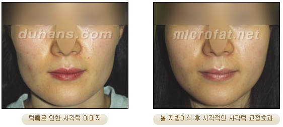 [두한성형외과 얼굴자가지방이식] - [볼살, 이마, 측두부] 관련 이미지 21