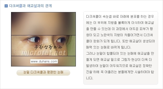 [두한성형외과 경쟁력 눈밑성형] - [눈밑 다크써클과 눈밑 애교살과의 관계 1.] 관련 이미지 3