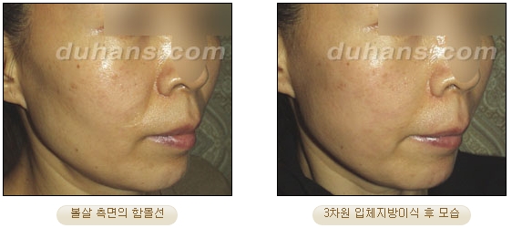 [두한성형외과 얼굴자가지방이식] - [볼살, 이마, 측두부] 관련 이미지 23