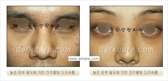 [두한성형외과 경쟁력 눈밑성형] - [젊은 눈매 하안검 성형술(눈밑주름 제거술)] 관련 이미지 5