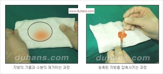 [두한성형외과 경쟁력 동안성형 리더] - ​[미간주름, 이마주름, 안검성형, 이마거상술, 눈썹거상술] 관련 이미지 4