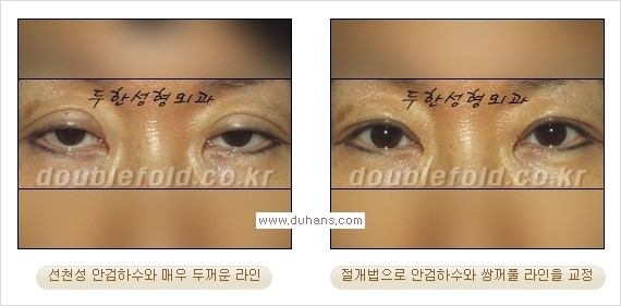 [두한성형외과 경쟁력 쌍꺼풀 재수술, 극한 눈재수술] - [안검하수 검사 및 수술방법 안내] 관련 이미지 16