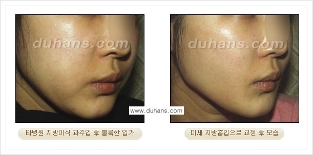 [두한성형외과 경쟁력 얼굴 미세지방이식] - [타병원에서 지방이식 후 굴곡과 과주입 교정 안내] 관련 이미지 7