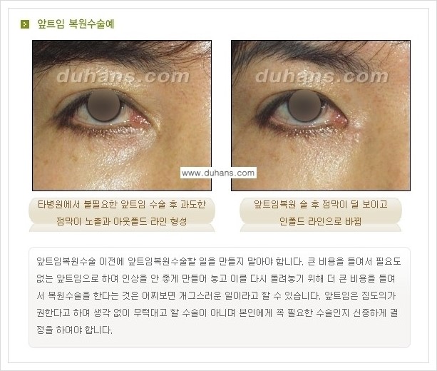 [두한성형외과 경쟁력 눈성형] - [앞트임 복원수술, 뒤트임 복원수술 안내] 관련 이미지 3