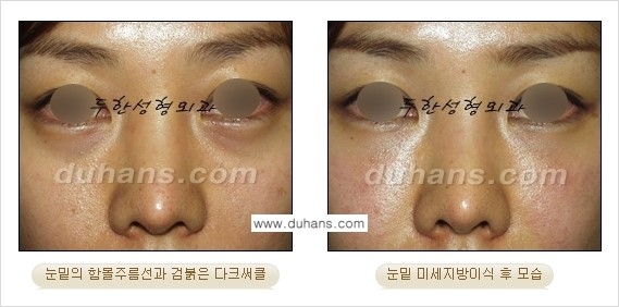[두한성형외과 경쟁력 미세지방이식] - [다크써클 & 눈밑주름 미세지방이식 3.] 관련 이미지 13