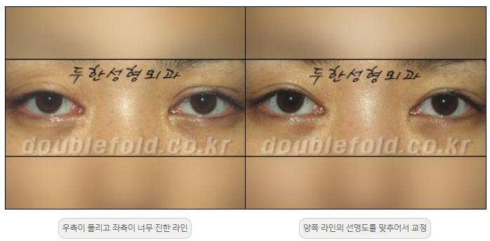 [두한성형외과 쌍커플재수술] - [비대칭 쌍커풀 라인] 관련 이미지 16