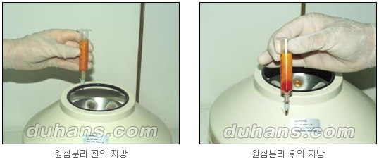 [두한성형외과 얼굴자가지방이식] - [귀족수술 입체 미세지방이식] 관련 이미지 8