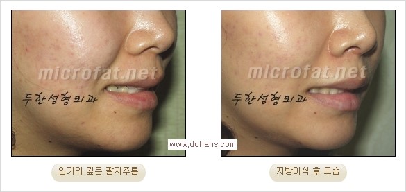 [두한성형외과 경쟁력 주름성형] - [입가와 팔자의 주름제거 지방이식 2.] 관련 이미지 4