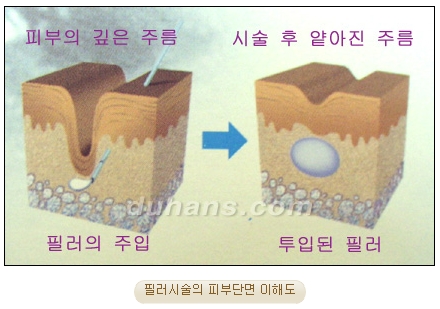 ​[두한성형외과 안티에이징] - [보톡스, 필러, 지방이식을 이용한 주름개선] 관련 이미지 10