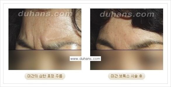 [두한성형외과 경쟁력 주름성형] - [얼굴 주름제거 보톡스 안내] 관련 이미지 7