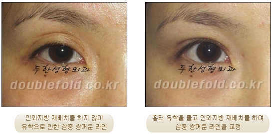 [두한성형외과 쌍수] - [재수술 실패의 원인, 재수술의 성공 요건] 관련 이미지 7