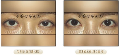 [두한성형외과 쌍커풀재수술] - [심한 소세지눈, 두줄따기, 쌍꺼풀 흉터] 관련 이미지 15