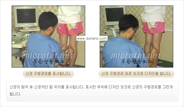 [두한성형외과 경쟁력 멀티종아리성형] - [초음파 유도 비절개 선택적 신경차단술의 효과] 관련 이미지 9
