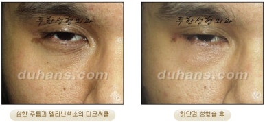 Blepharoplasty, Duhan Plastic Surgery - Upper and Lower Eyelids image 38