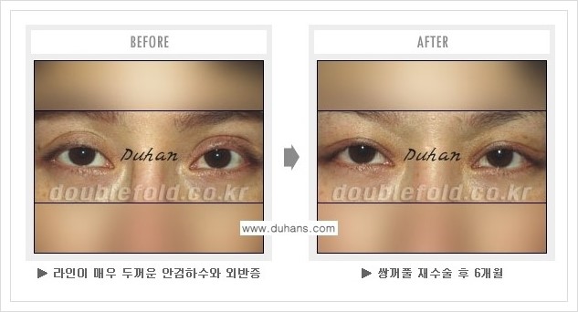 [두한성형외과] - [쌍꺼풀 재수술 푸는 수술을 하고 내원했을 경우의 문제] 관련 이미지 4