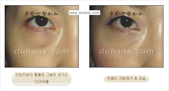 [두한성형외과 젊은 눈매 안검성형] - [눈밑 지방제거의 수술 전후 안내 ①] 관련 이미지 16