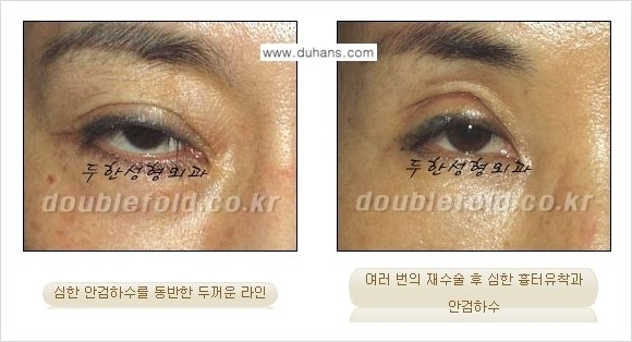 [두한성형외과 경쟁력 쌍꺼풀 재수술 스페셜] - [망가진 라인을 교정하는 극한 재수술] 관련 이미지 2